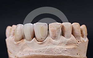 Close up of dental prothetic jaw. photo