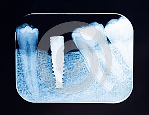 Close up Dental X Ray implant