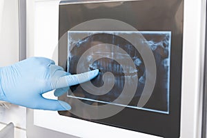 Close-up of dentist showing x-ray to a patient