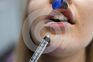 Close-up of a dentistry patient`s mouth during a doctor`s checkup.
