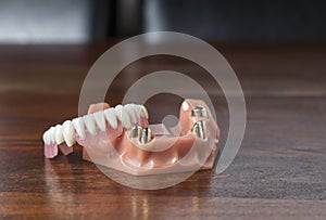 Close up of dentures with gold teeth