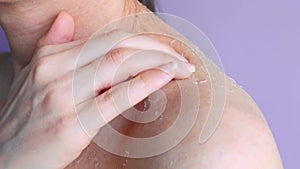 Close-up dermatitis on shoulder and neck side view dermatitis as result of poor hygiene white skin under influence of