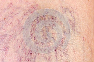 Close-up of dermis with varicose veins