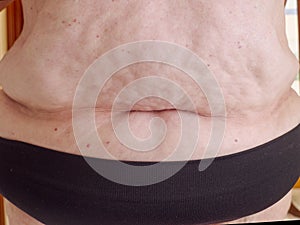 Close-up detail of the abdomen and waist of a woman with obesity, adiposity or obesity