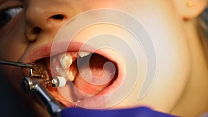 Close-up detail of dentist doctor doing professional cleaning dental plaque and polishing child`s teeth at stomatology