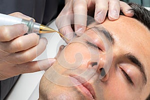 Close up detail of laser plasma pen removing facial melanoma on middle aged man