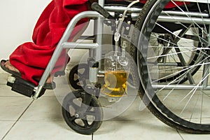 Close up disabled person in a wheelchair in a hospital or clinic to which the urine catheter drainage bag is attached which is fil