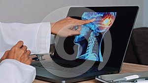 Close up of doctor showing a x-ray of skull with pain on the back of the brain on a laptop