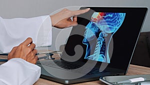 Close up of doctor showing a x-ray of skull with pain in the brain on a laptop