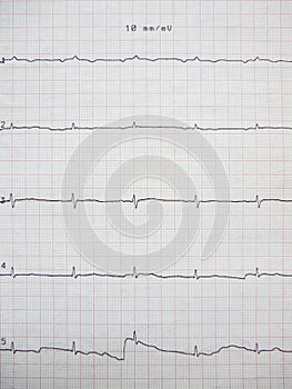 Close up of ECG graph