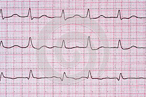 Close Up Echocardiograph test report ECG showing abnormal heart rhythm