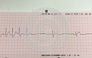 Close-up of EKG printout