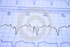 Close-up of an EKG tracing of a patient with a cardiac pacemaker. Pacemaker beats recorded on paper