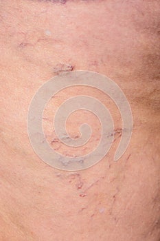 Close-up of an elderly woman`s leg, which develops a disease of varicose veins