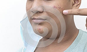 Close up face of teenage guy with acne and problem skin. Skin after wearing mask for prolonged can damage the skin