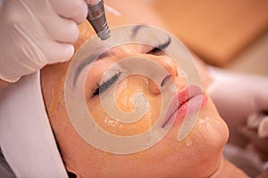 Close up of facial treatment with acupuncture pen