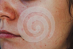 Close-up of a female face: problematic oily skin, enlarged pores, redness, acne, black spots
