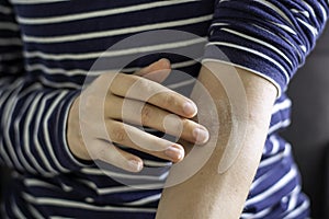Close up female hands applying ointment on crook of arm elbow. Apply a soothing cream in the treatment and hydration of the skin.