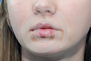 Close-up of female lips suffering from herpes. Lips virus infected herpes