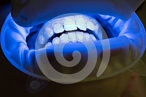 Close up of female mouth. Matching the shades of the implants or the process of teeth whitening. Dentist with an