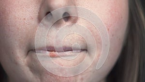 Close-up of female problem skin with herpes on lips. Media. Well-groomed skin of face with black spots and inflammation