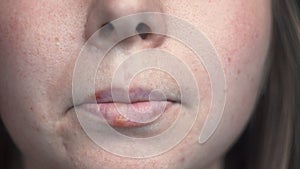 Close-up of female problem skin with herpes on lips. Media. Well-groomed skin of face with black spots and inflammation