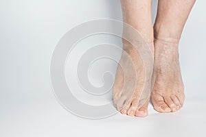 Close-up female sore skin of feet, dry heels isolated on a white background