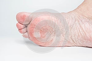 Close-up female sore skin of feet, dry heels isolated on a white background