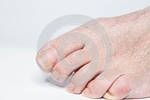 Close-up female sore skin of feet, dry heels isolated on a white background