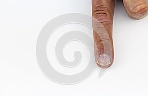 Close-up of a finger with Psoriatic onychodystrophy against a white background