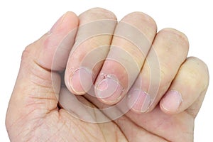 Close-up of fingers and nails with dry skin, torn and flaking off