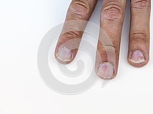 Close-up of a fingers with Psoriatic onychodystrophy against a white background