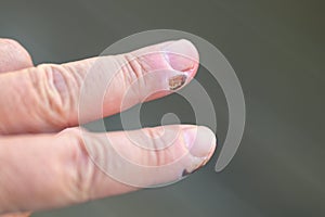 Close up on the fingers of a senior man with healing sores