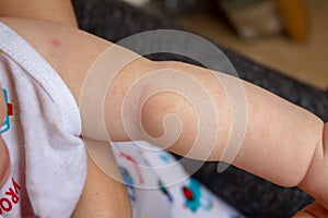 Prickly heat. Close-up of the folds of the hand of a newborn baby with red skin. photo