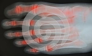 Close up foot x-ray