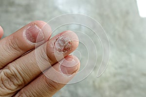 Close up of fungus nail infection. Fungal infection on nails hand, finger with onychomycosis, damage on human hand on gray