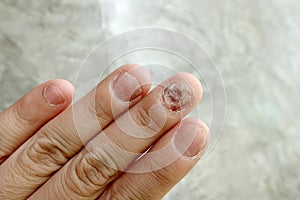 Close up of fungus nail infection. Fungal infection on nails hand, finger with onychomycosis, damage on human hand on gray