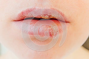 Close up of girl lips affected by herpes. Treatment of herpes infection and virus. Part of young woman face, lips with herpes