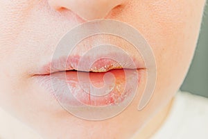 Close up of girl lips affected by herpes. Treatment of herpes infection and virus. Part of young woman face, lips with