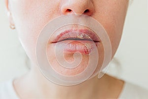 Close up of girl lips affected by herpes. Treatment of herpes infection and virus. Part of young woman face, lips with herpes