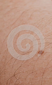 Close up of a Hairy skin with a mole.