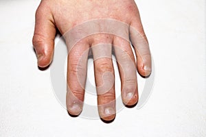 Close up of hand with bitten finger and fingernails.