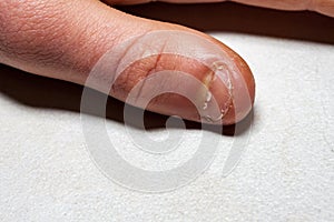 Close up of hand with bitten finger and fingernails.