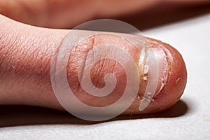 Close up of hand with bitten finger and fingernails.