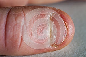 Close up of hand with bitten finger and fingernails.