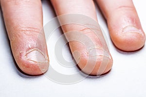 Close up of hand with bitten finger and fingernails.