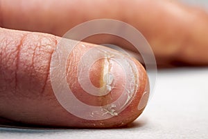 Close up of hand with bitten finger and fingernails.