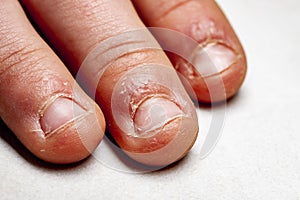 Close up of hand with bitten finger and fingernails.