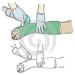 Close-up hand cutting plaster cast at leg and foot patient to immobilize after fracture injury vector illustration sketch doodle