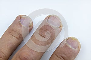 close up of Hand and fingers with Psoriatic onychodystrophy or psoriatic nails. psoriasis unguium